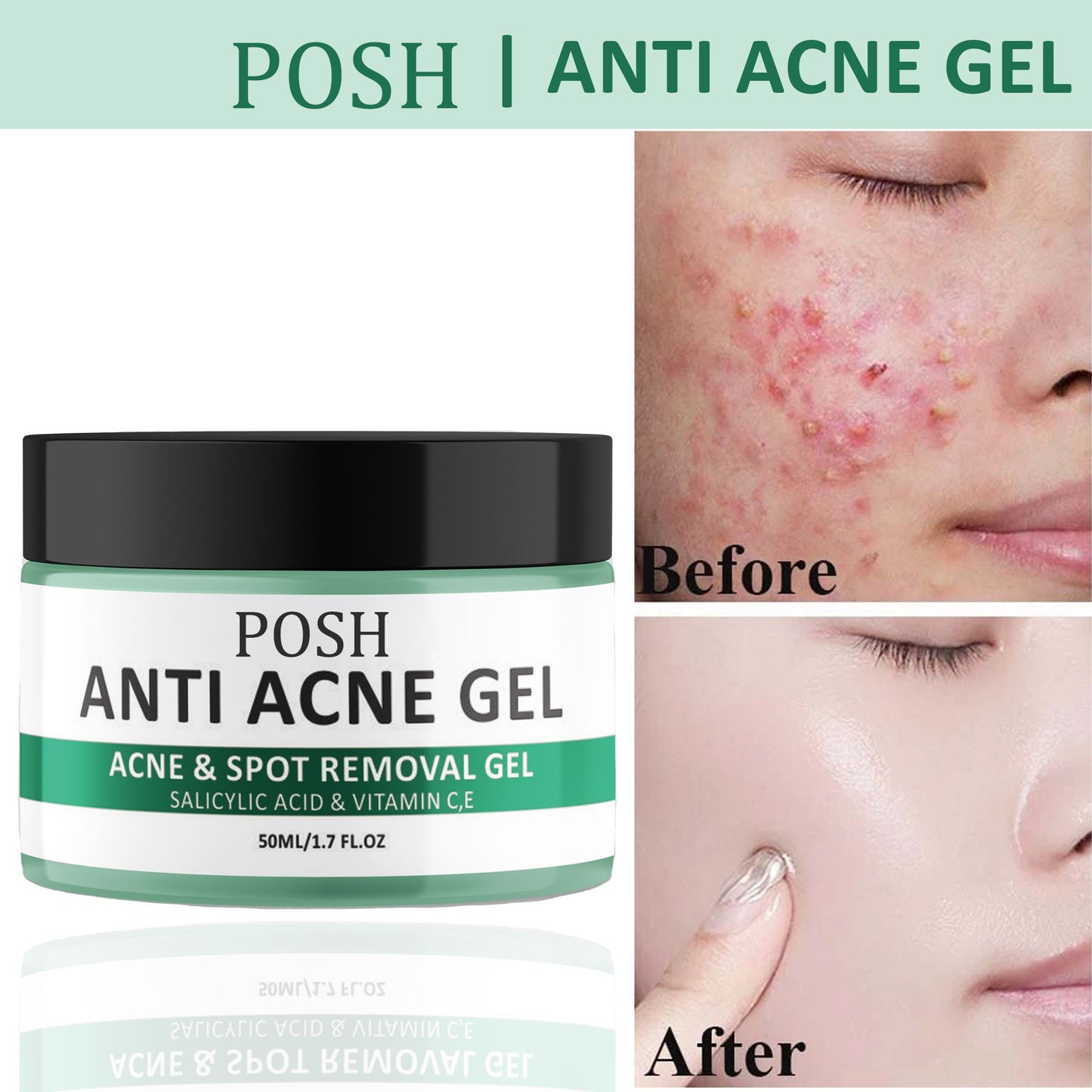 POSH Anti Acne Cream for Acne Prone Skin and Acne Scars Marks with Niacinamide and Salicylic Acid | Anti Acne Face Treatment for Dark Spots