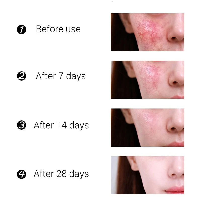POSH Anti Acne Cream for Acne Prone Skin and Acne Scars Marks with Niacinamide and Salicylic Acid | Anti Acne Face Treatment for Dark Spots