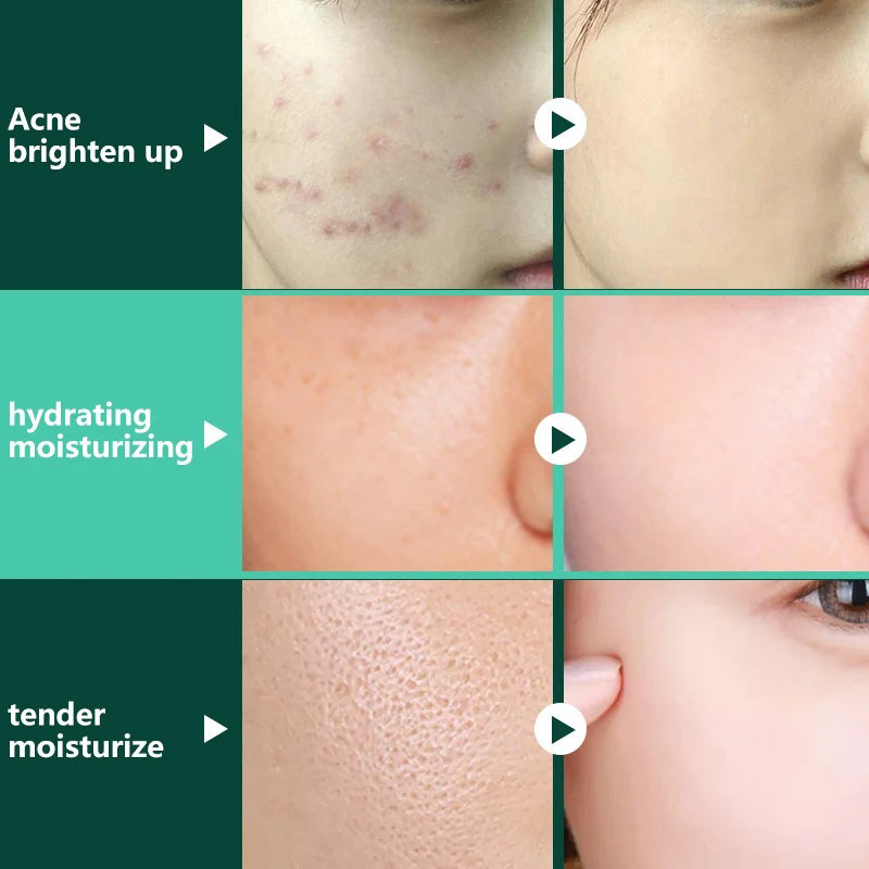 POSH Anti Acne Cream for Acne Prone Skin and Acne Scars Marks with Niacinamide and Salicylic Acid | Anti Acne Face Treatment for Dark Spots