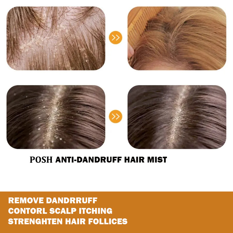 POSH Anti Dandruff Hair Mist For Dandruff Removal and Itching Control For all Hair types