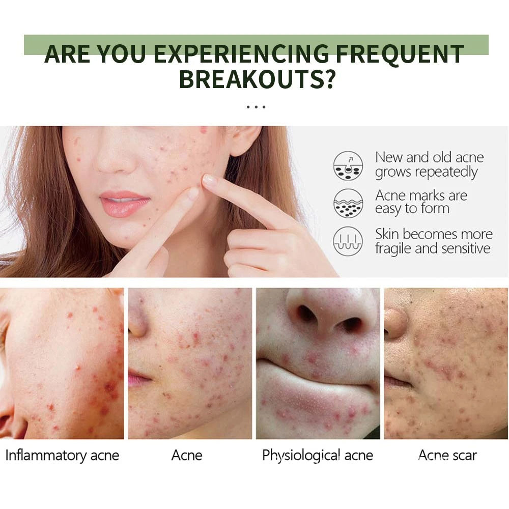 POSH Anti Acne Cream for Acne Prone Skin and Acne Scars Marks with Niacinamide and Salicylic Acid | Anti Acne Face Treatment for Dark Spots